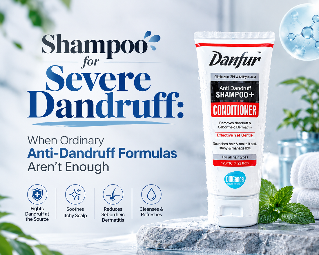 Shampoo for Severe Dandruff: When Ordinary Anti-Dandruff Formulas Aren't Enough - Danfur Shampoo and Conditioner